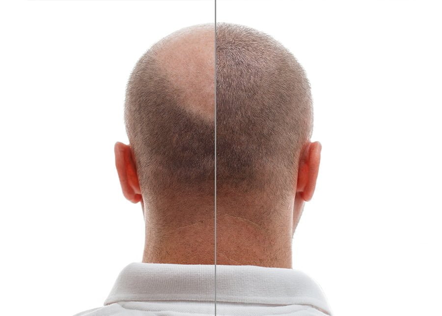 Trattamenti per il trapianto di capelli