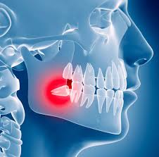 Estrazione Denti del Giudizio in Turchia | Cayra Clinics