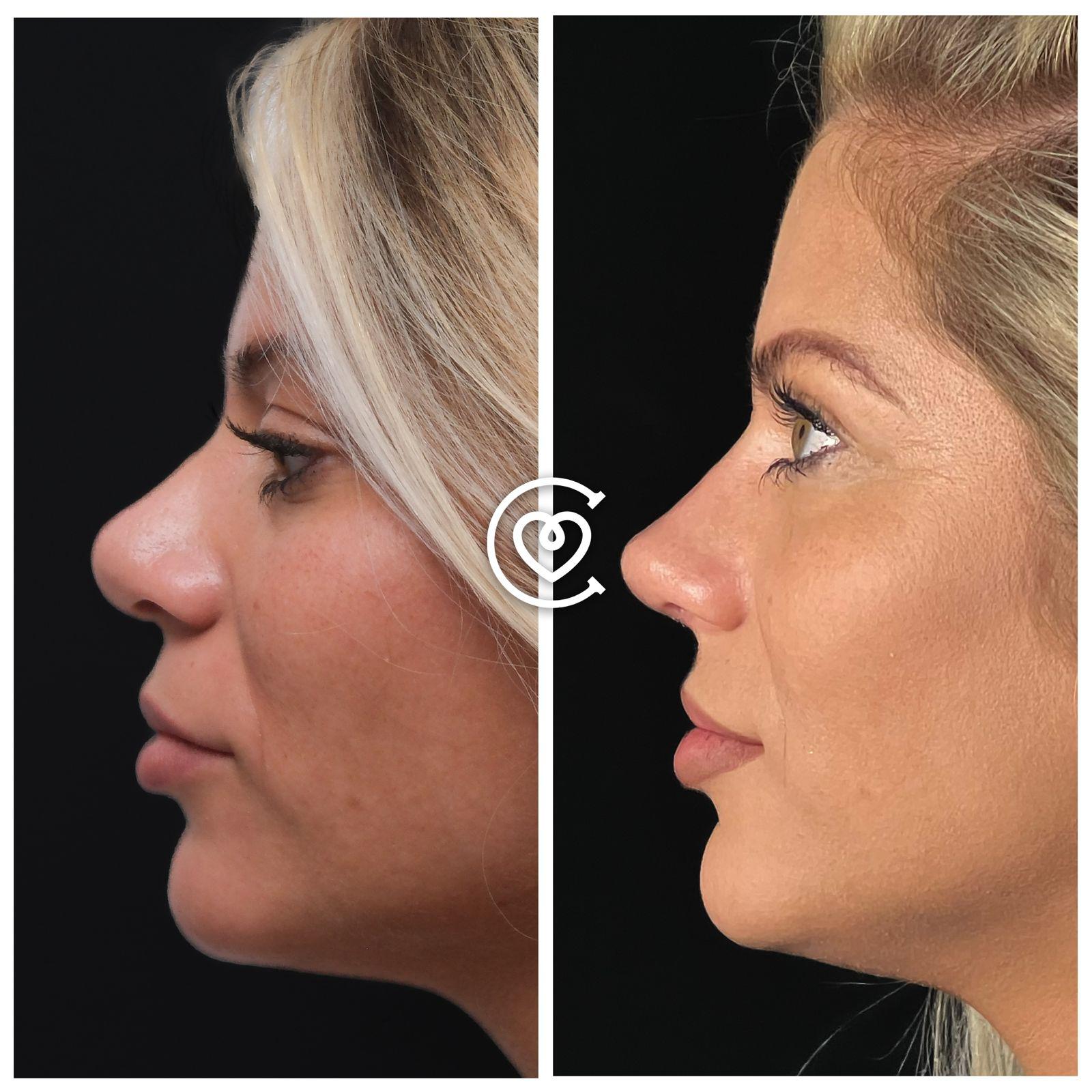 Rinoplastica di Revisione in Turchia | Cayra Clinics