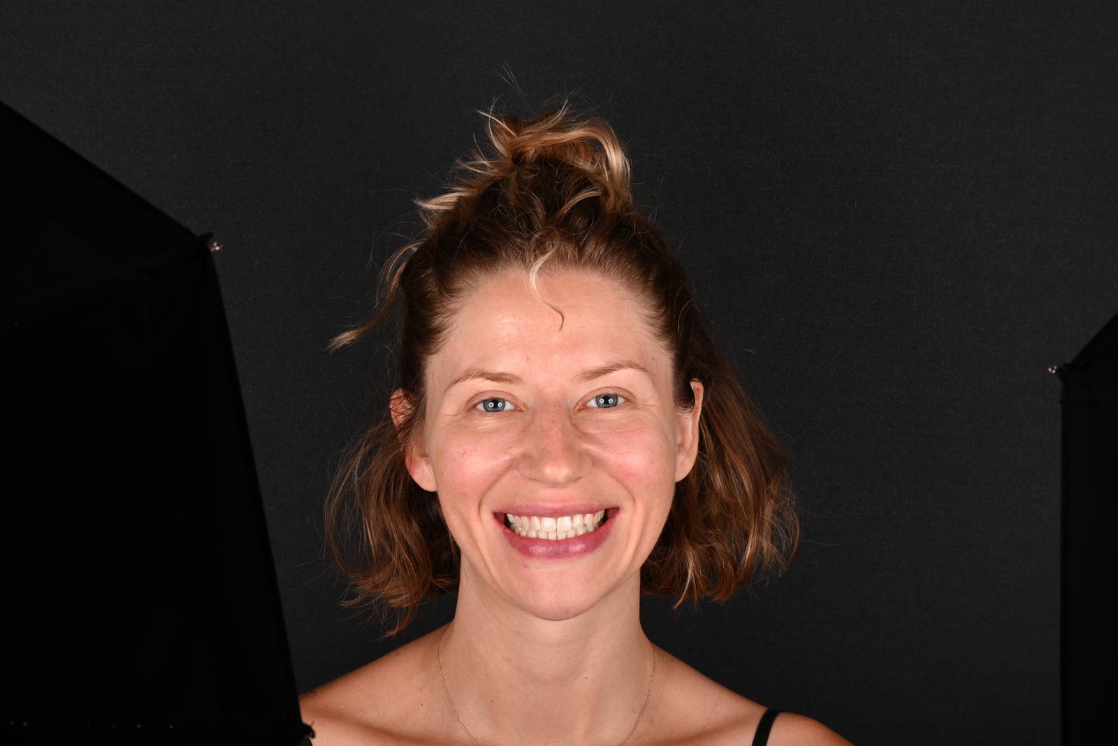 Sbiancamento dentale a Istanbul e Antalya | Cayra Clinics