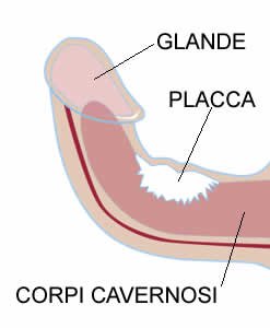 Trattamento della Malattia di La Peyronie a Cayra Clinics