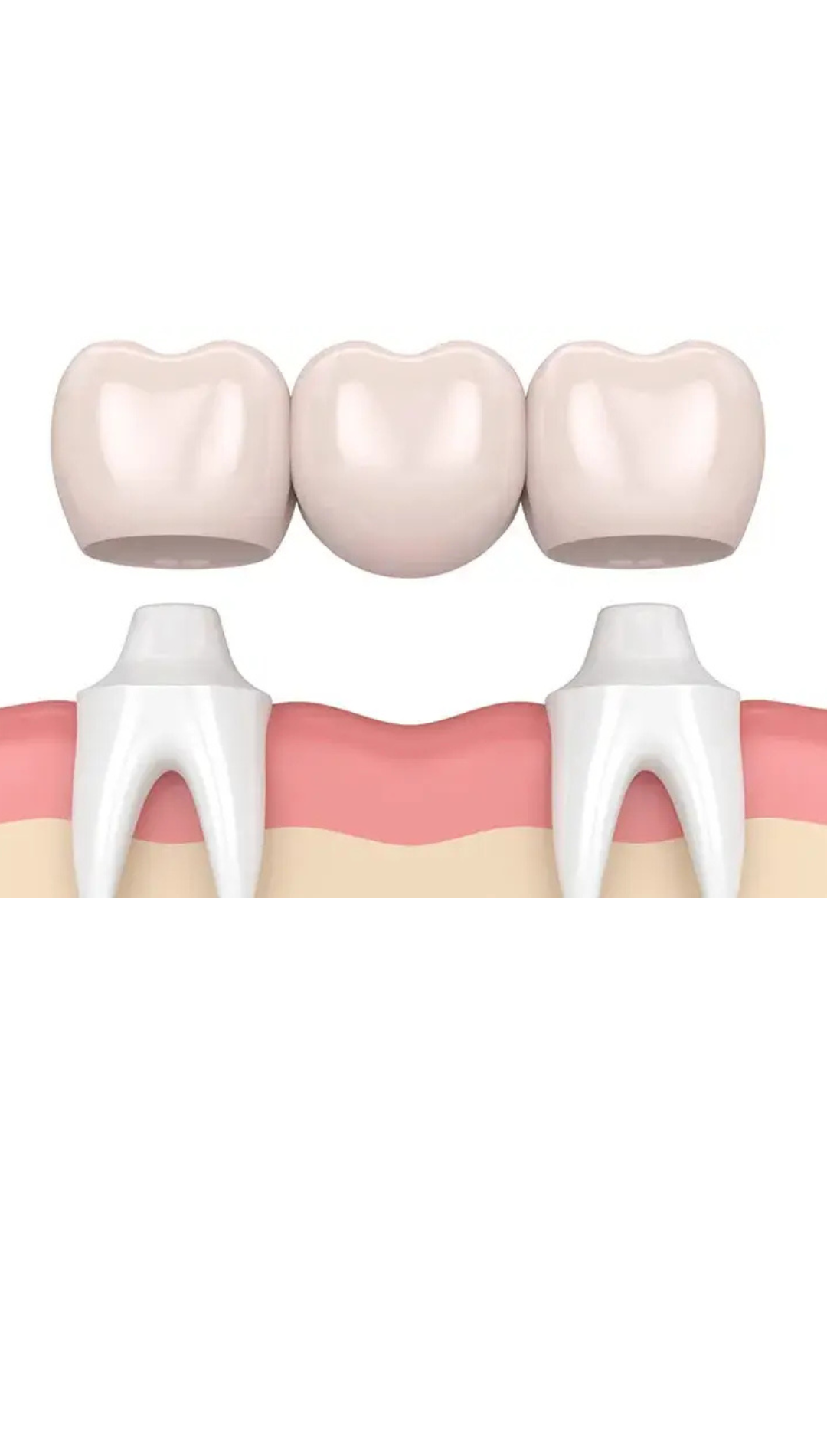 Ponte dentale fisso di alta qualità a Cayra Clinic per sostituire denti mancanti e migliorare il sorriso