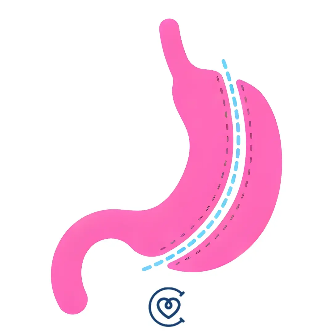 Sleeve Gastrectomy in Turchia