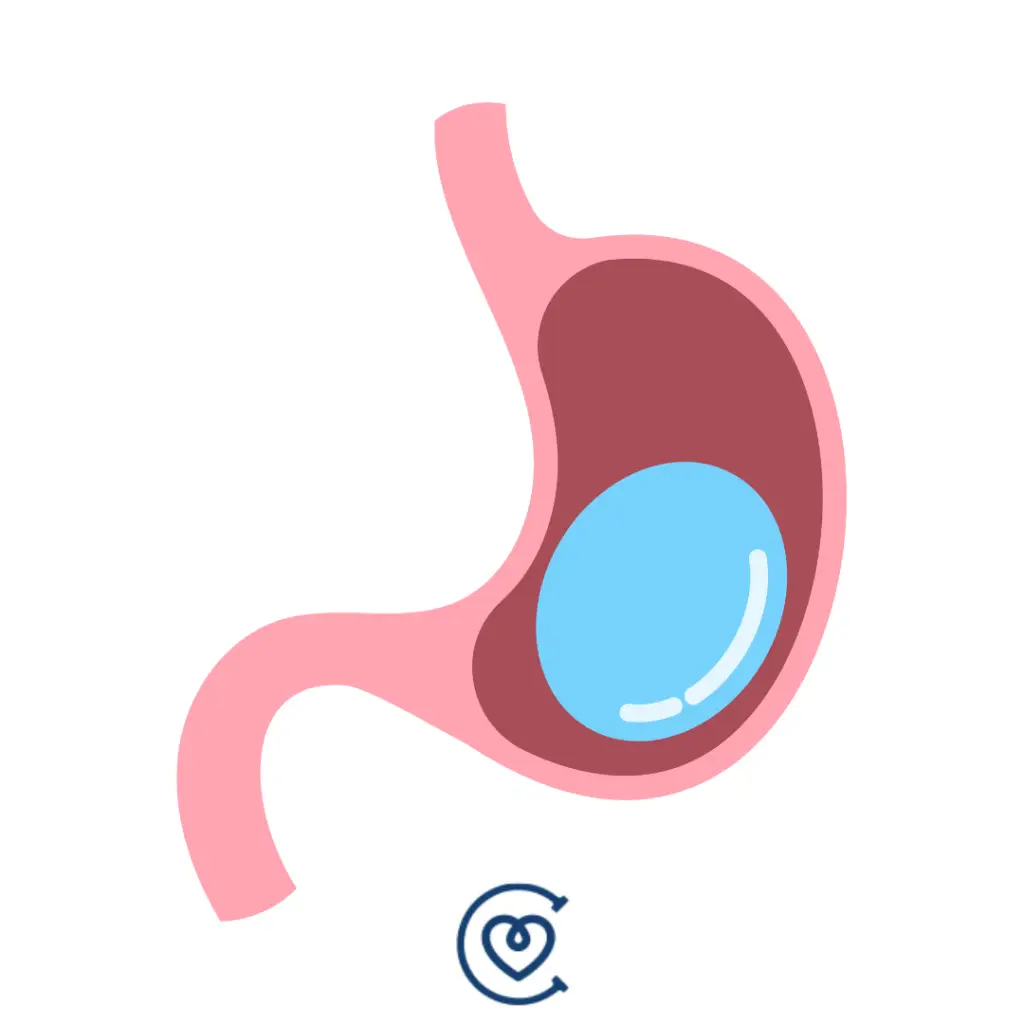 Palloncino Gastrico in Turchia