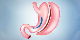 Paziente sottoposto a sleeve gastrectomy presso Cayra Clinic per una perdita di peso duratura