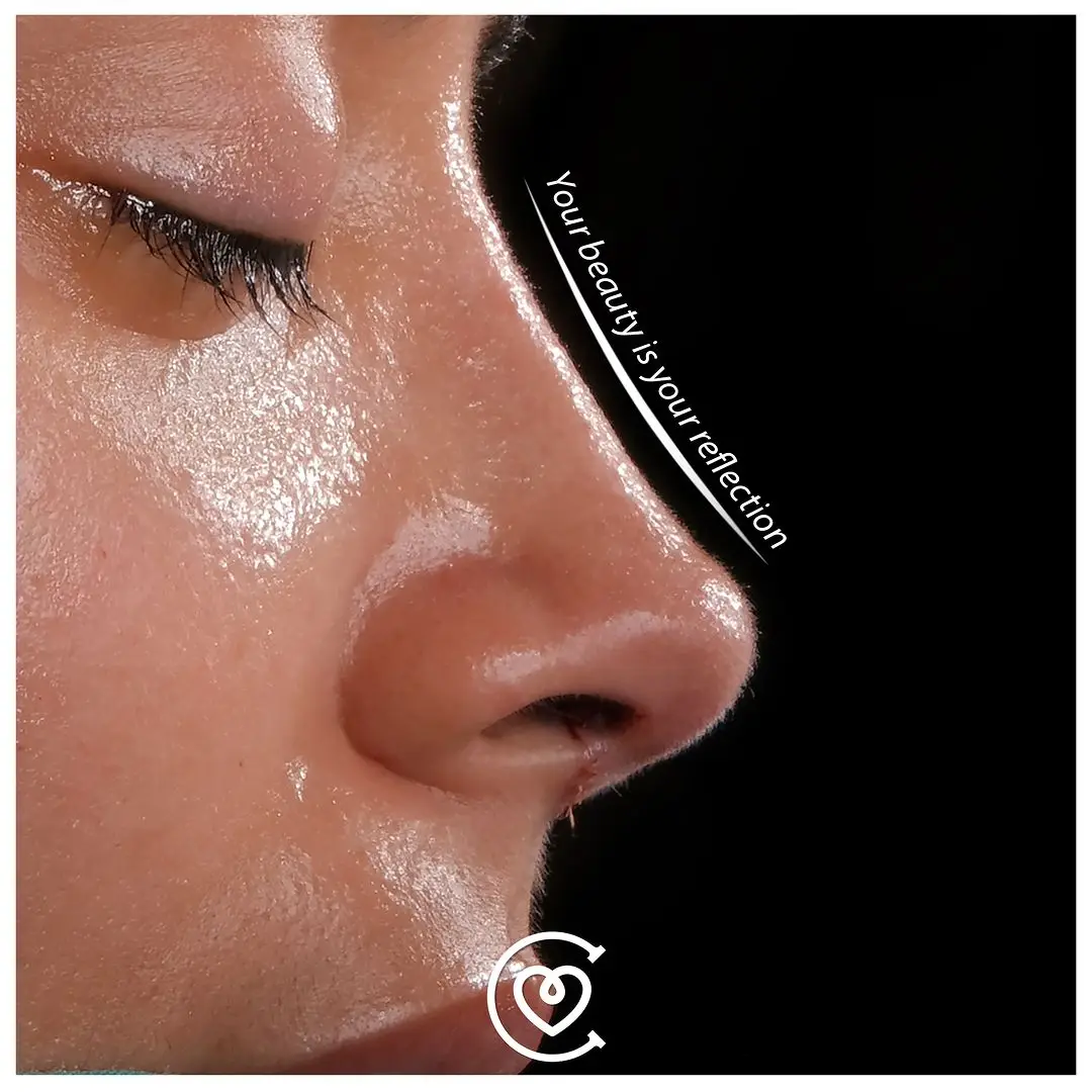 Interventi di rinoplastica a Cayra Clinic per migliorare l’estetica e la funzionalità del naso