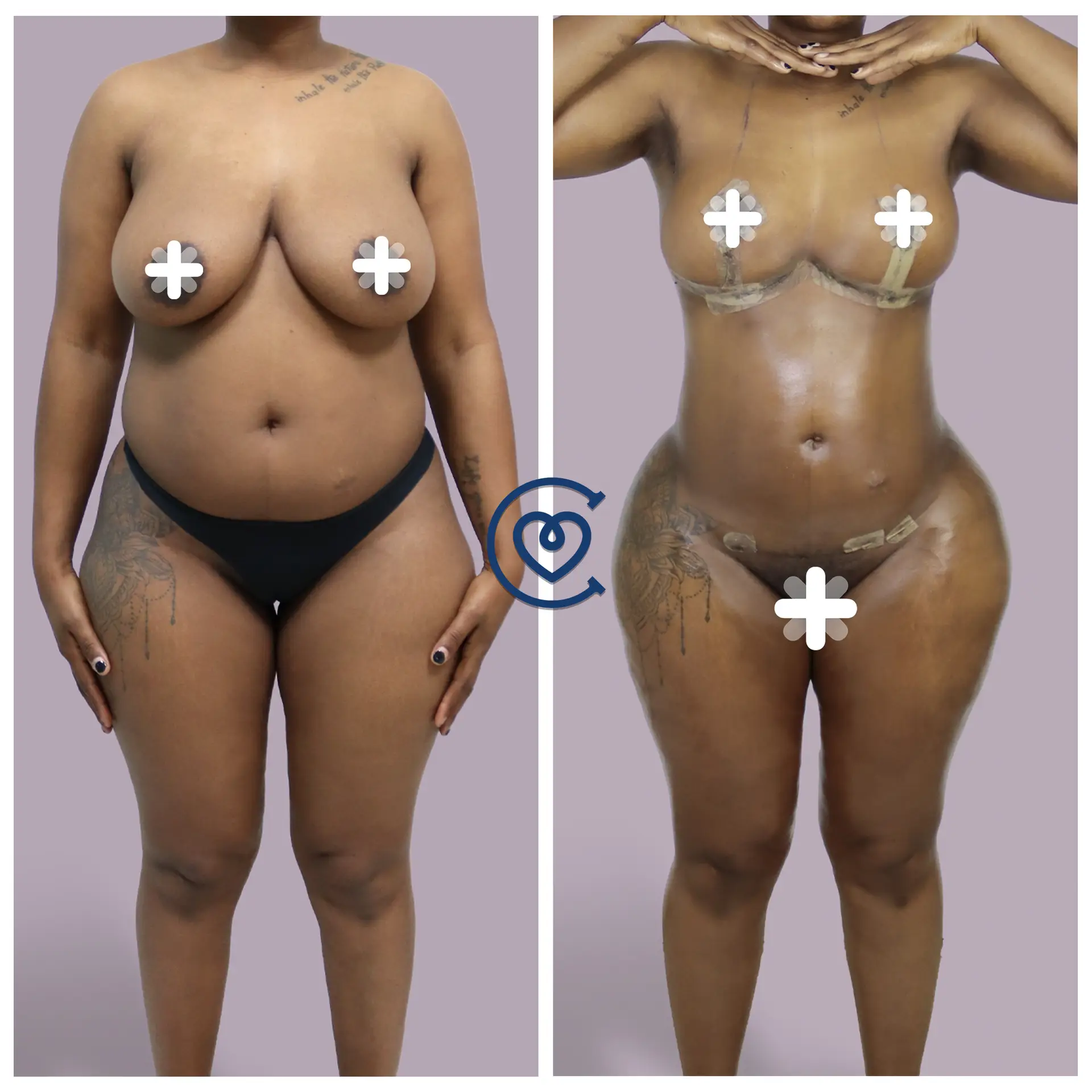 Intervento di liposuzione a Cayra Clinic per rimodellare il corpo e rimuovere depositi di grasso