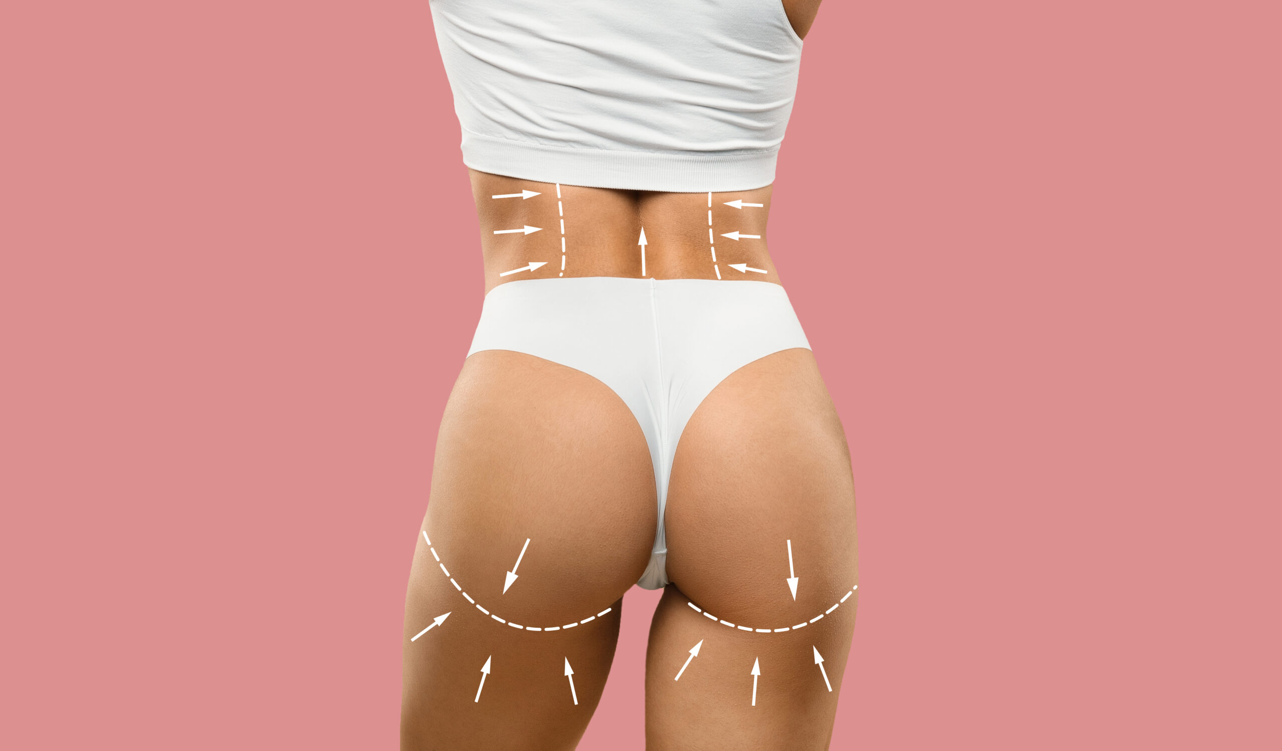 Trattamento con filler PMMA per glutei a Cayra Clinic per aumentare volume e definizione naturale