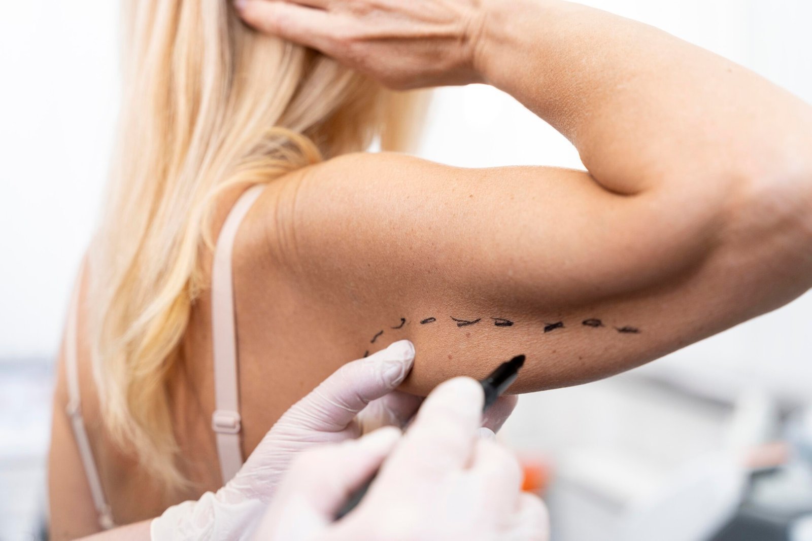 Risultati prima e dopo la liposuzione delle braccia presso Cayra Clinic per un rimodellamento naturale