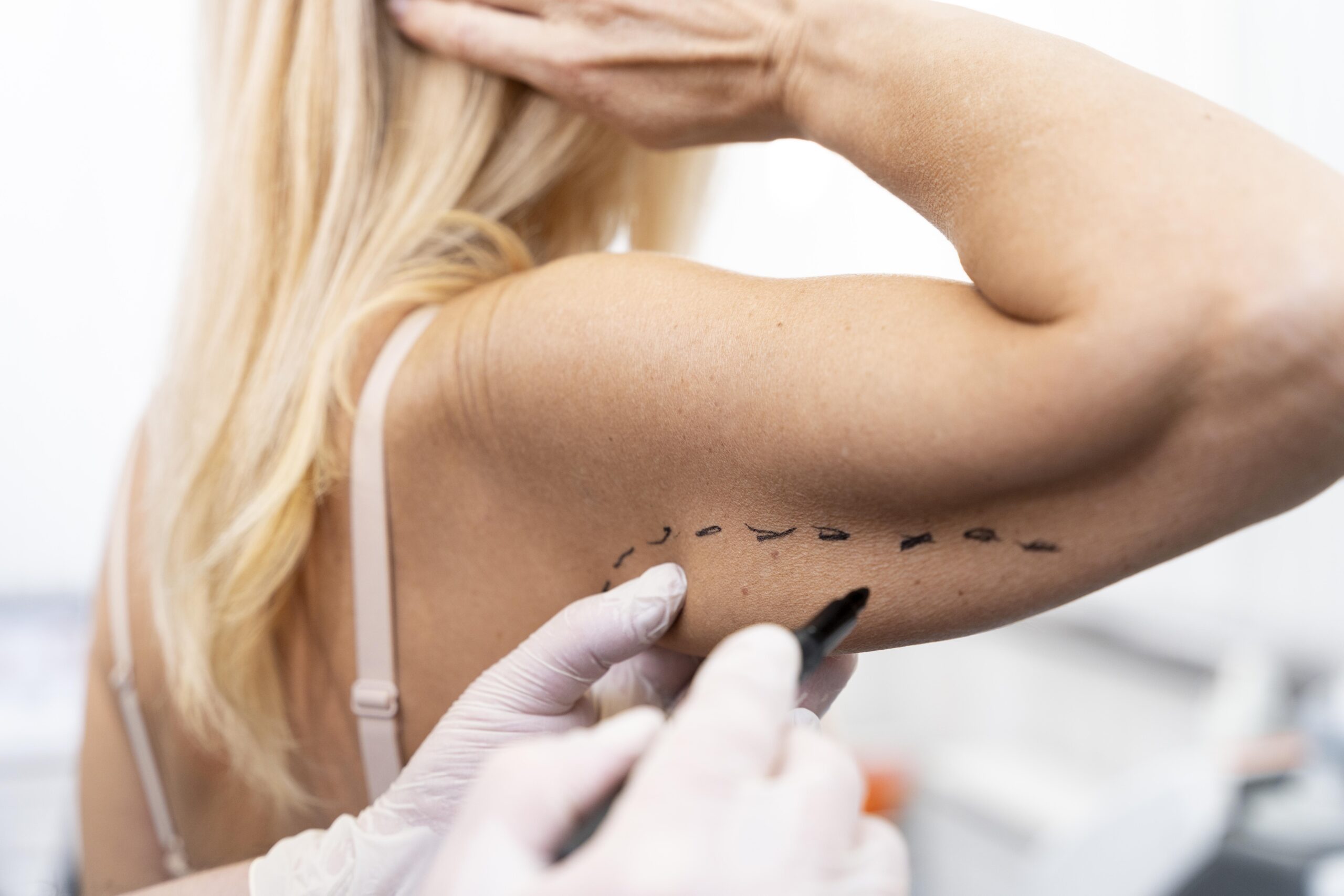 Risultati prima e dopo la liposuzione delle braccia presso Cayra Clinic per un rimodellamento naturale