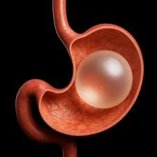 Palloncino gastrico sei mesi a Cayra Clinic per supportare la perdita di peso in modo sicuro ed efficace