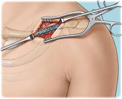Guida di Cayra Clinic sui rischi e sugli effetti collaterali della clavicle shortening surgery