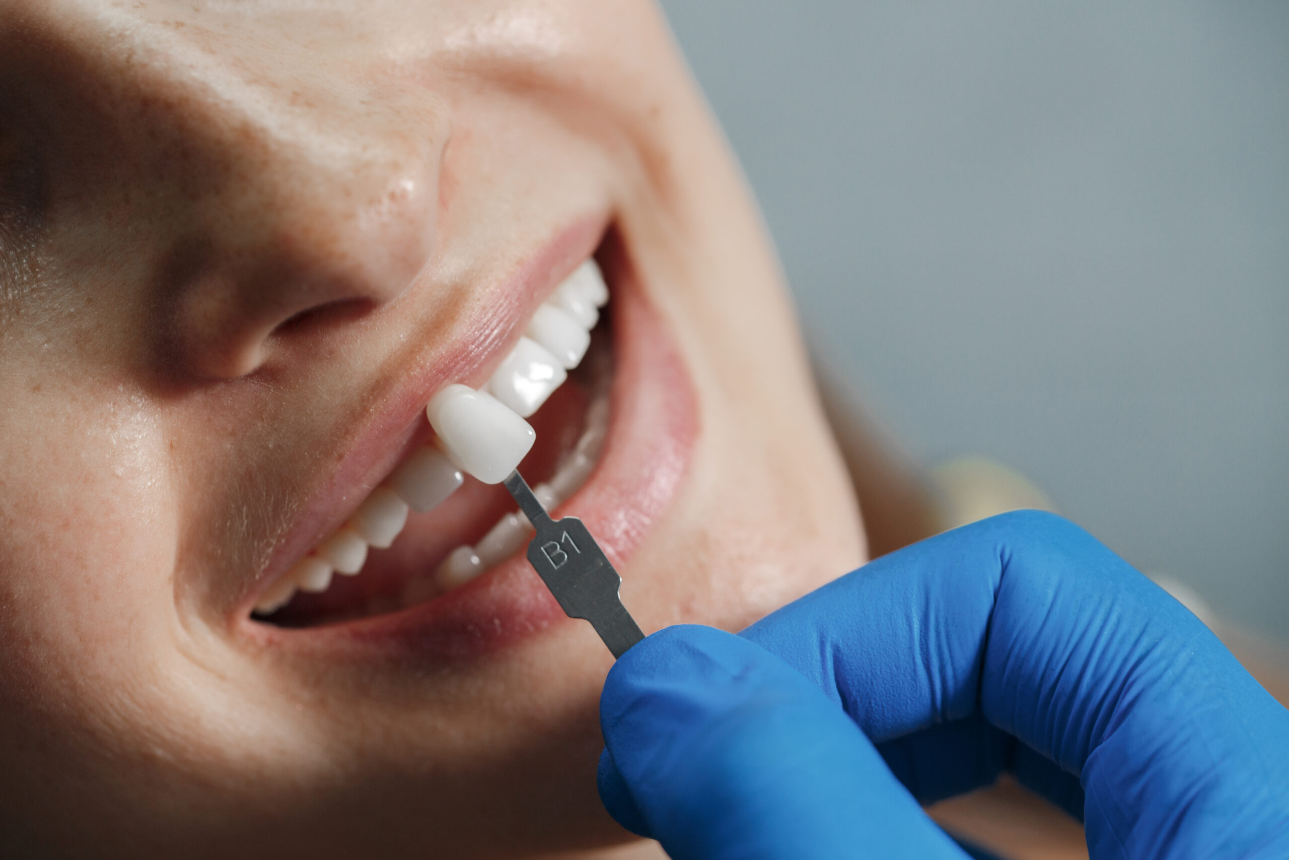I denti in zirconio ingialliscono nel tempo informazioni sulla durata e sul colore