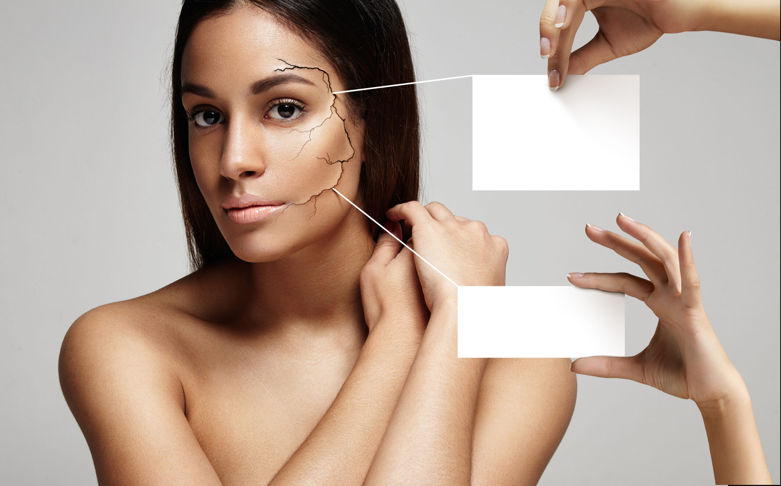 Lifting non chirurgico con fili tensori presso Cayra Clinic per un viso più definito e ringiovanito