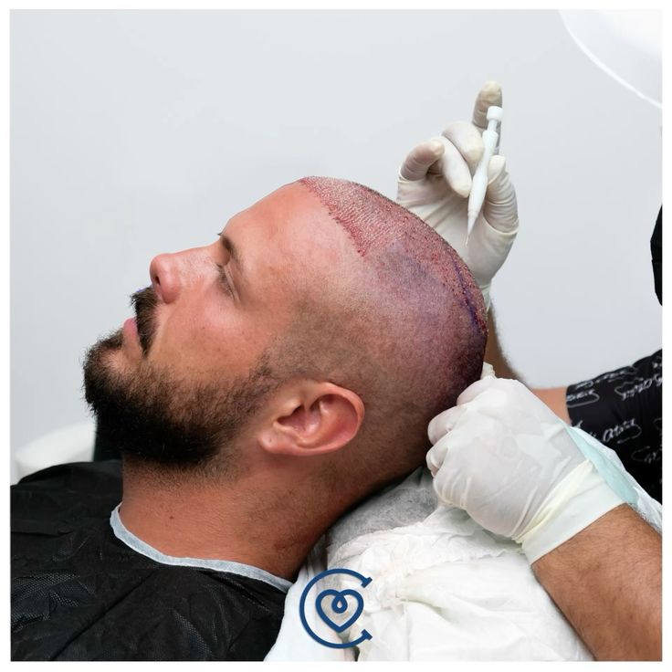 Micropigmentazione del cuoio capelluto a Cayra Clinic per un effetto rasato naturale