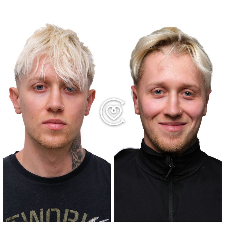 Otoplastica presso Cayra Clinic per correggere la forma e la posizione delle orecchie.