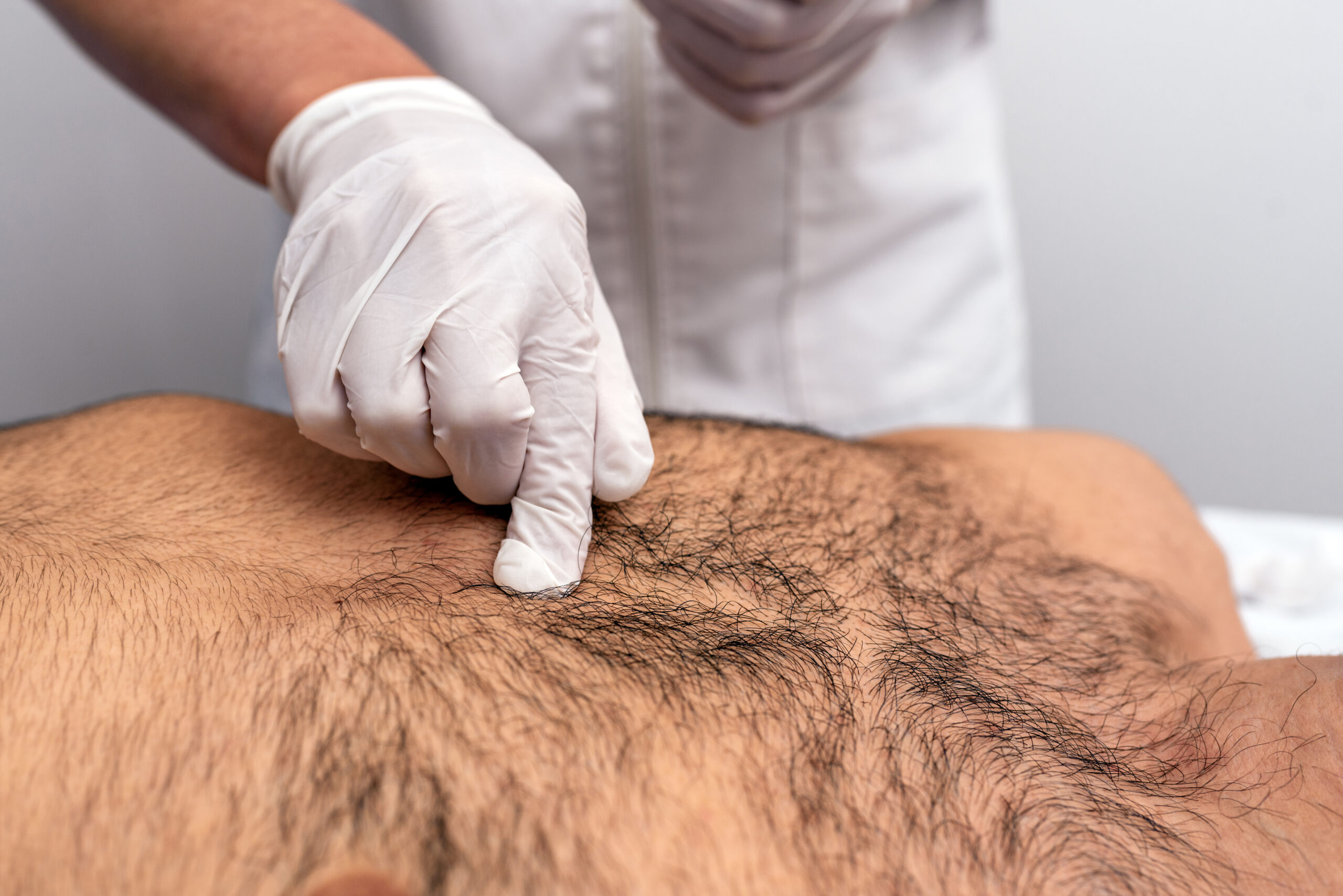 Procedura avanzata di trapianto di capelli con innesti corporei dal torace