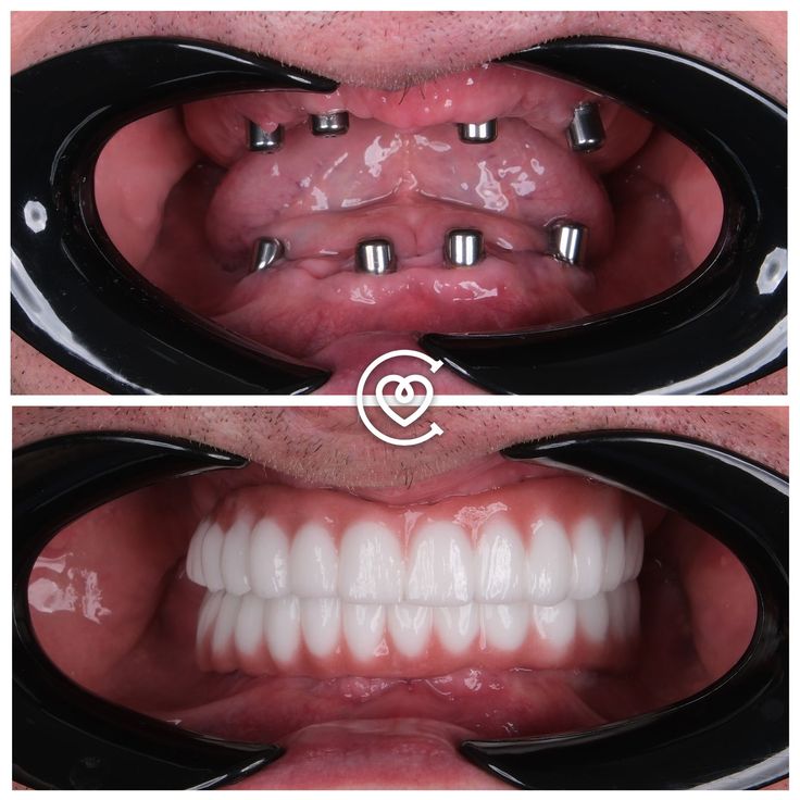 Costo impianto dentale in Turchia guida completa 2026