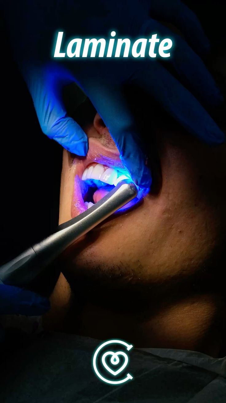 Faccette laminate per un sorriso bianco e naturale