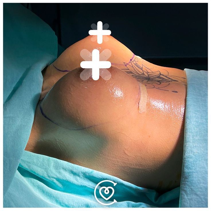 Lipofilling al seno in Turchia 2026