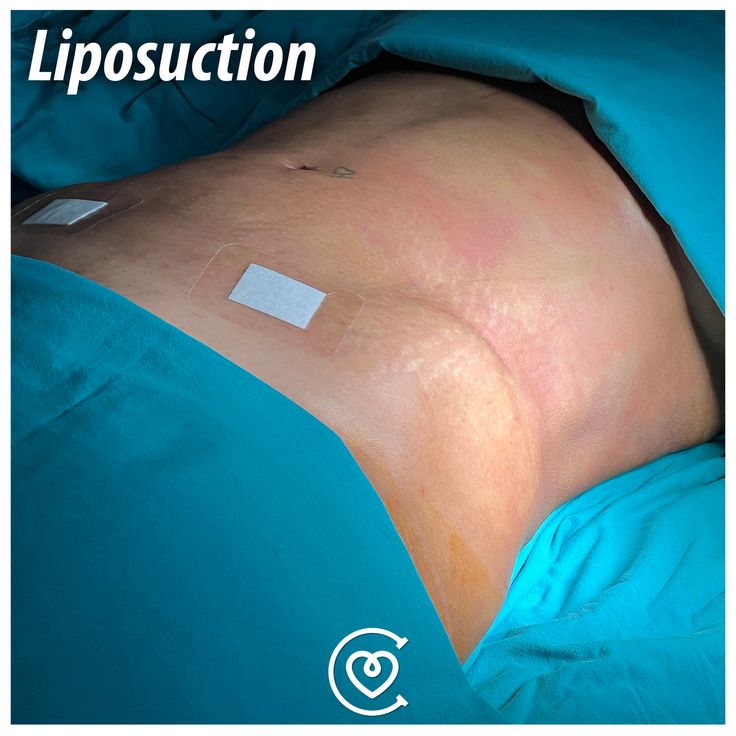 Opzioni di liposuzione sicure per pazienti HIV positivi a Istanbul