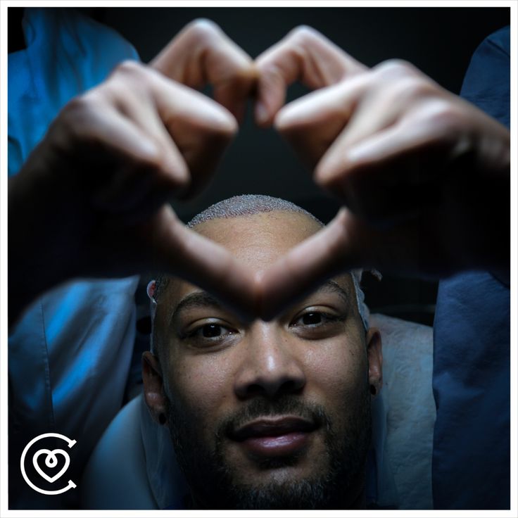 Opzioni di trapianto di capelli sicure per pazienti HIV positivi a Istanbul