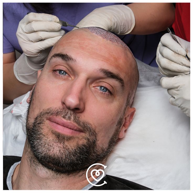 Tecniche moderne di trapianto di capelli per persone con HIV a Istanbul