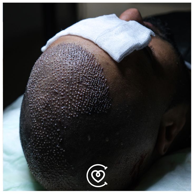 Un trapianto di capelli mal riuscito può essere corretto