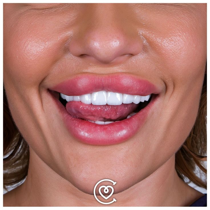 Hollywood Smile a Istanbul con digital design per un risultato naturale