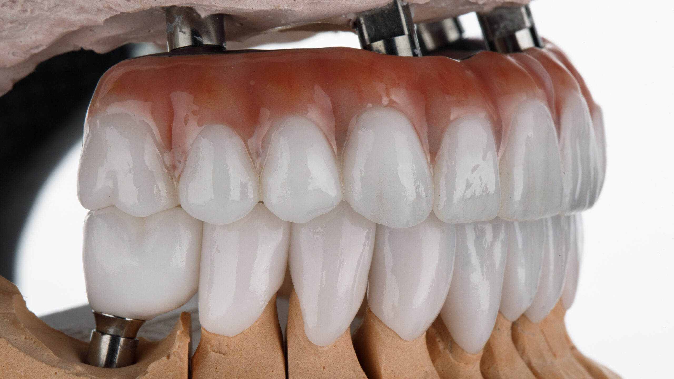 Impianti dentali All on 4 per sorriso fisso