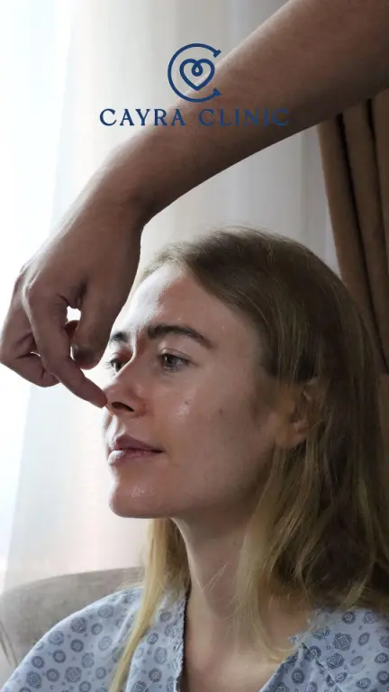 Rinoplastica piezo in Turchia con recupero rapido