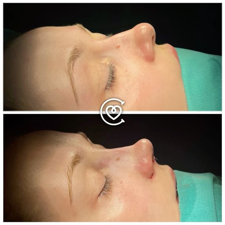 Prima e dopo rinoplastica in Turchia con Cayra Clinic