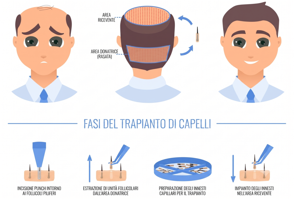 Procedura di trapianto di capelli robotizzato