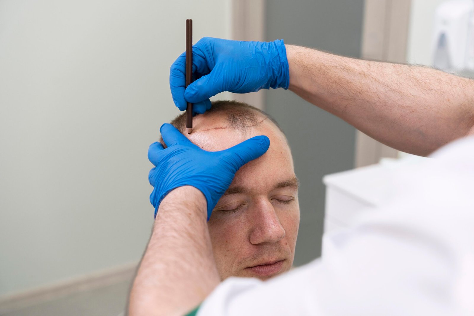 Trapianto di capelli DHI