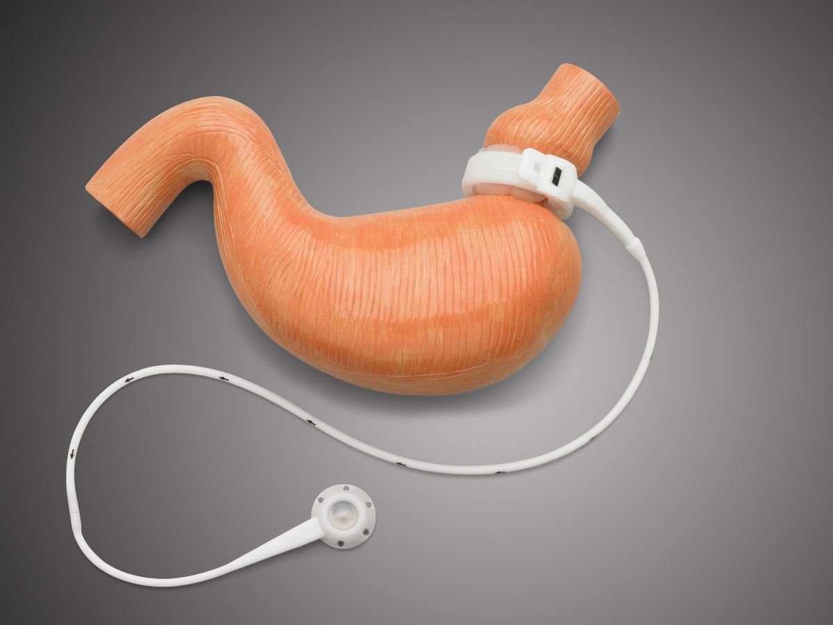 Risultati di perdita di peso e trasformazione corporea prima e dopo il bendaggio gastrico