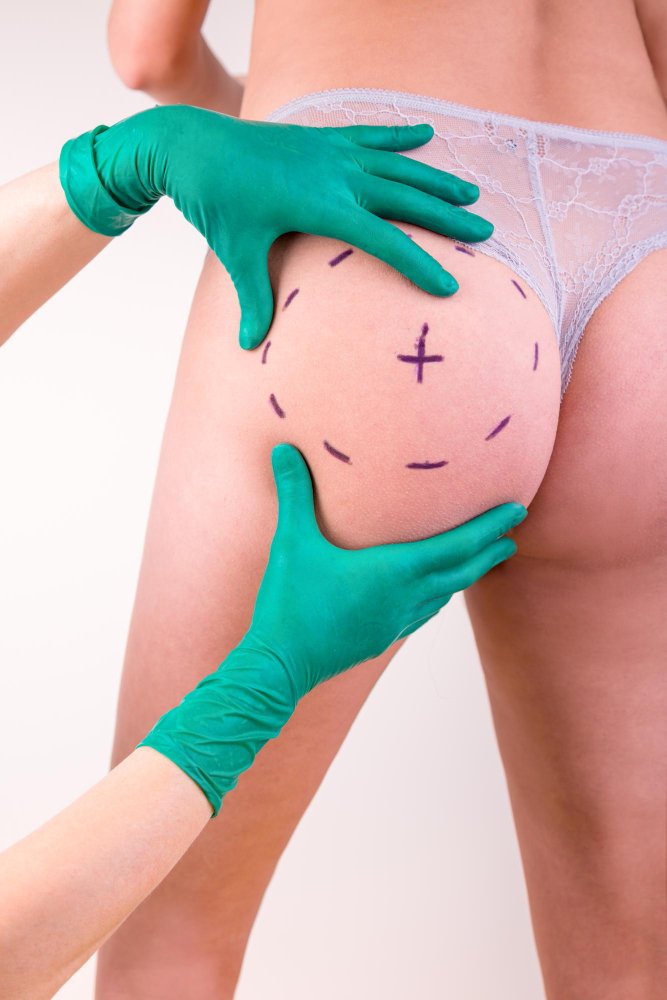 Guaina compressiva indossata dopo un intervento di aumento dei glutei