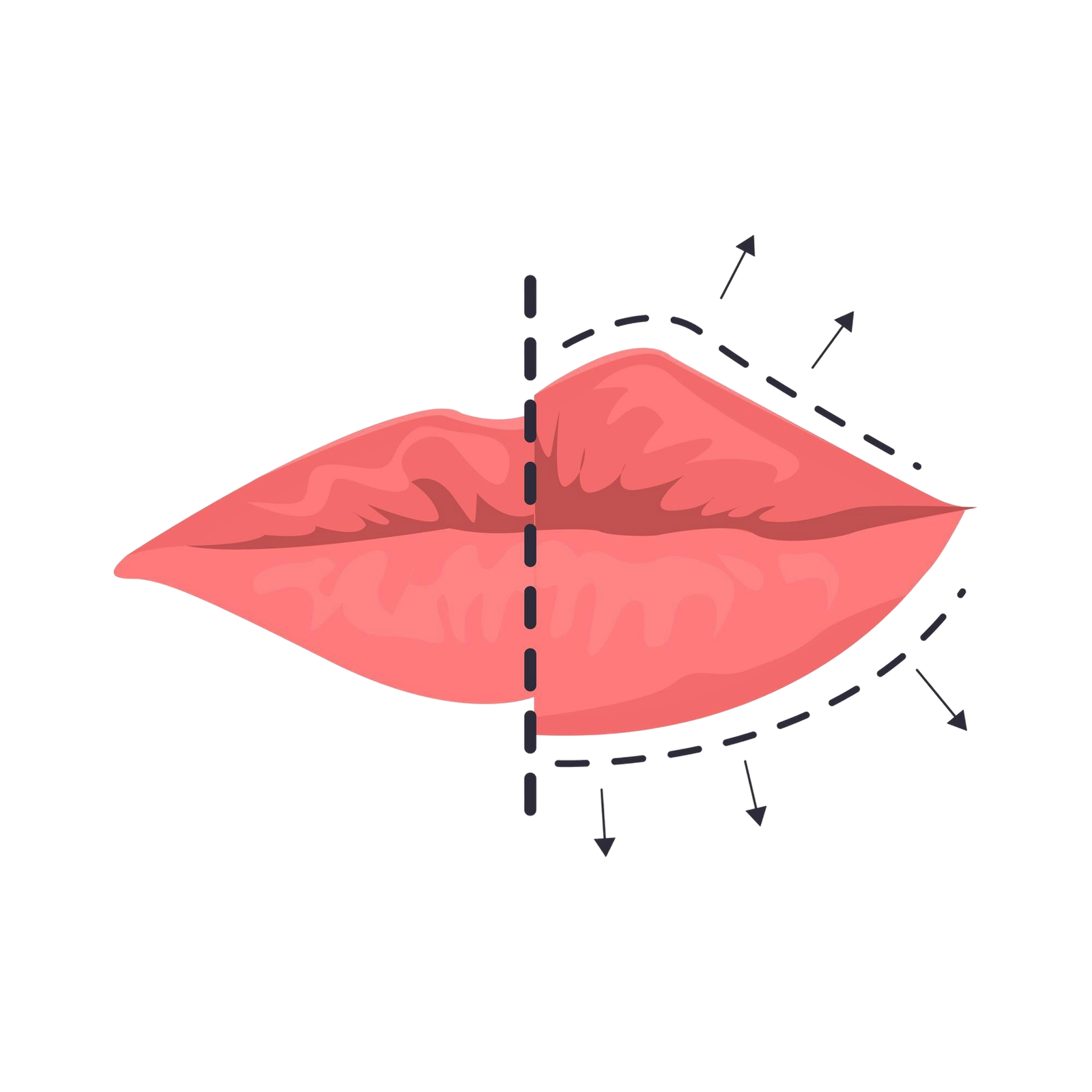 Labbro superiore di una paziente dopo il lip lift in Turchia