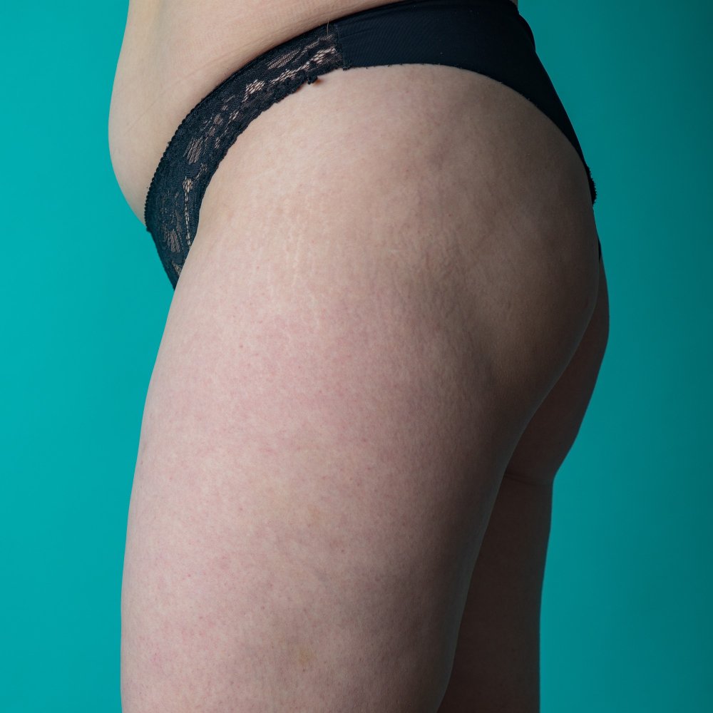 Esterno coscia prima e dopo la liposuzione in Turchia