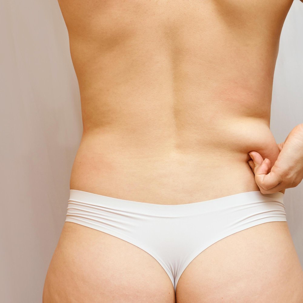 Fianchi rimodellati dopo una liposuzione presso Cayra