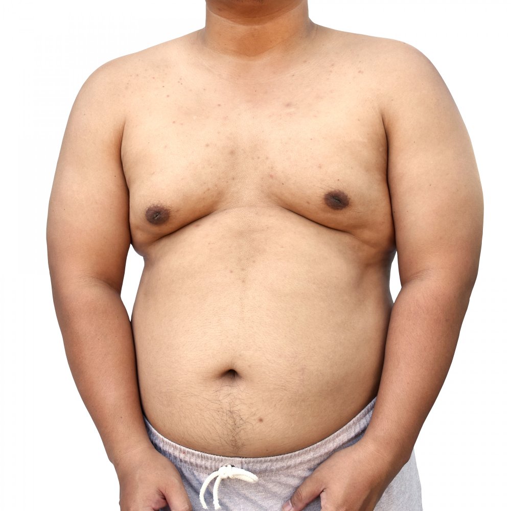 Petto maschile dopo una liposuzione eseguita in Turchia