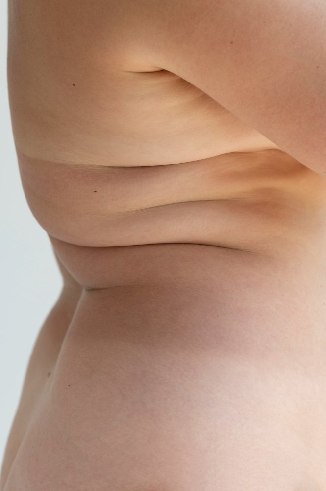 Rimodellamento del corpo dopo un intervento di chirurgia bariatrica