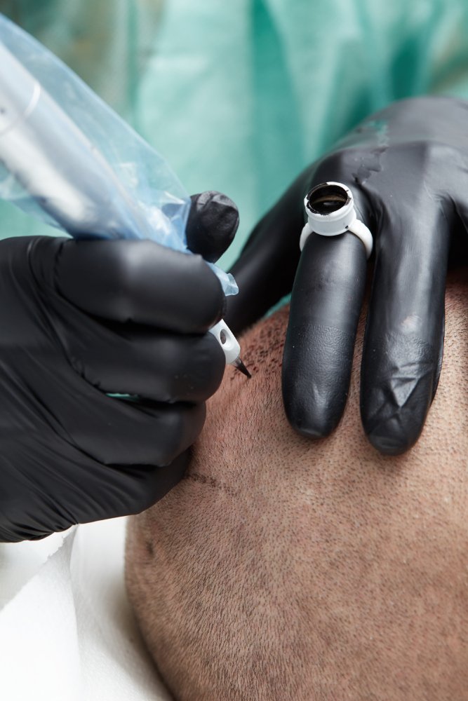 Confronto tra tricopigmentazione e trapianto di capelli in Turchia