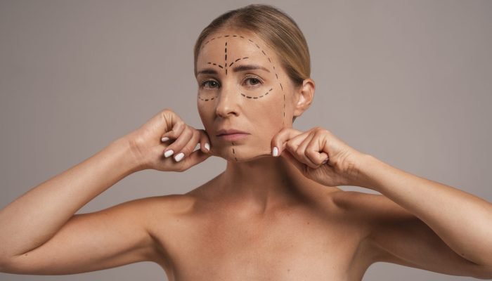 Lifting ragnatela in Turchia e Spider Web face lift non chirurgico presso Cayra Clinic